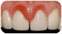 gingii inflamate